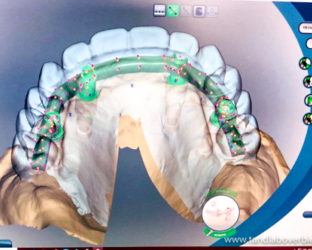 Tandlabo Verbiest Nieuwste technologie CAD-CAM