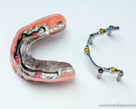 Tandprotheses